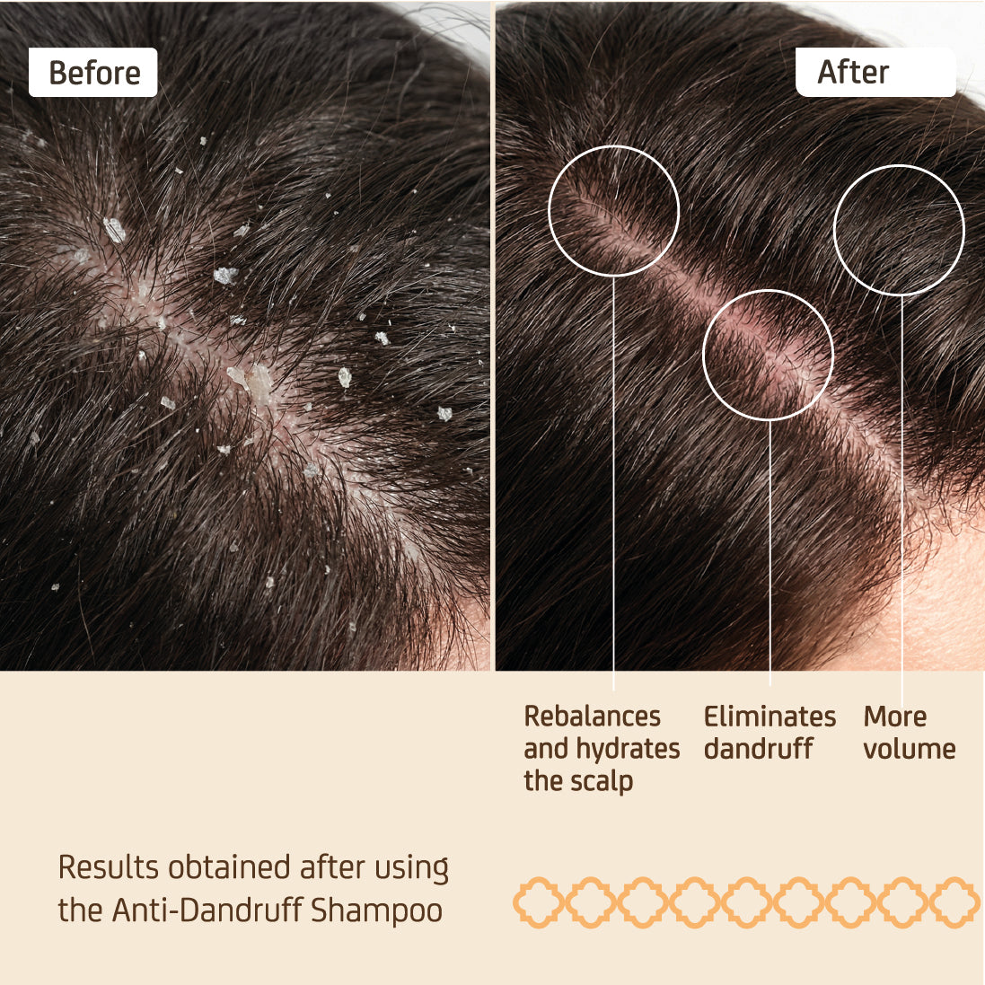 Anti Dandruff Kit