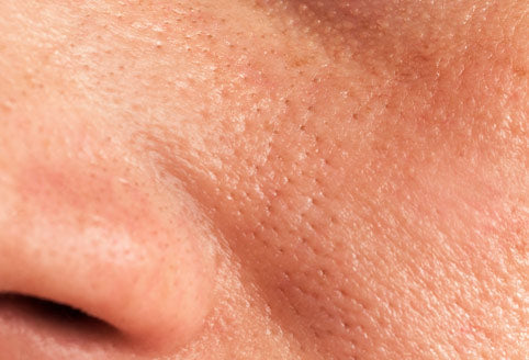 Große Poren verkleinern: Hilft Liquid Microneedling wirklich?
